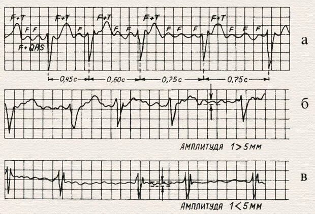 Мерцательная аритмия зубец р. Фибрилляция предсердий тахисистолическая форма ЭКГ. Мерцательная аритмия на ЭКГ. Мерцательная аритмия кардиограмма.