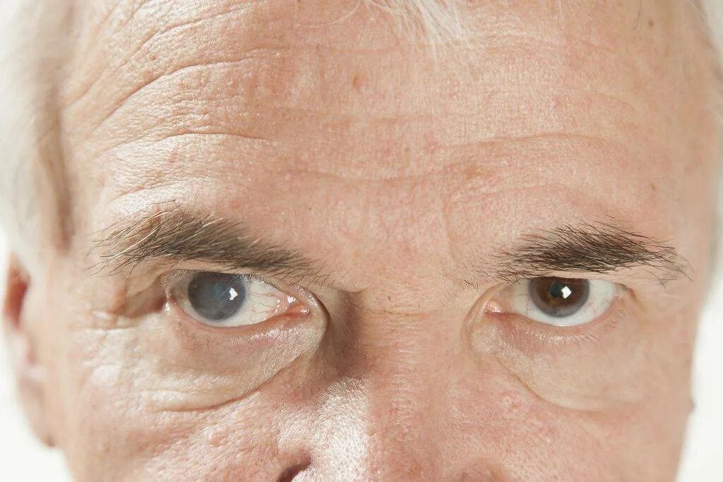 Старческая(сенильная)катаракта. Сенильная катаракта глаза. 1 признаки катаракты