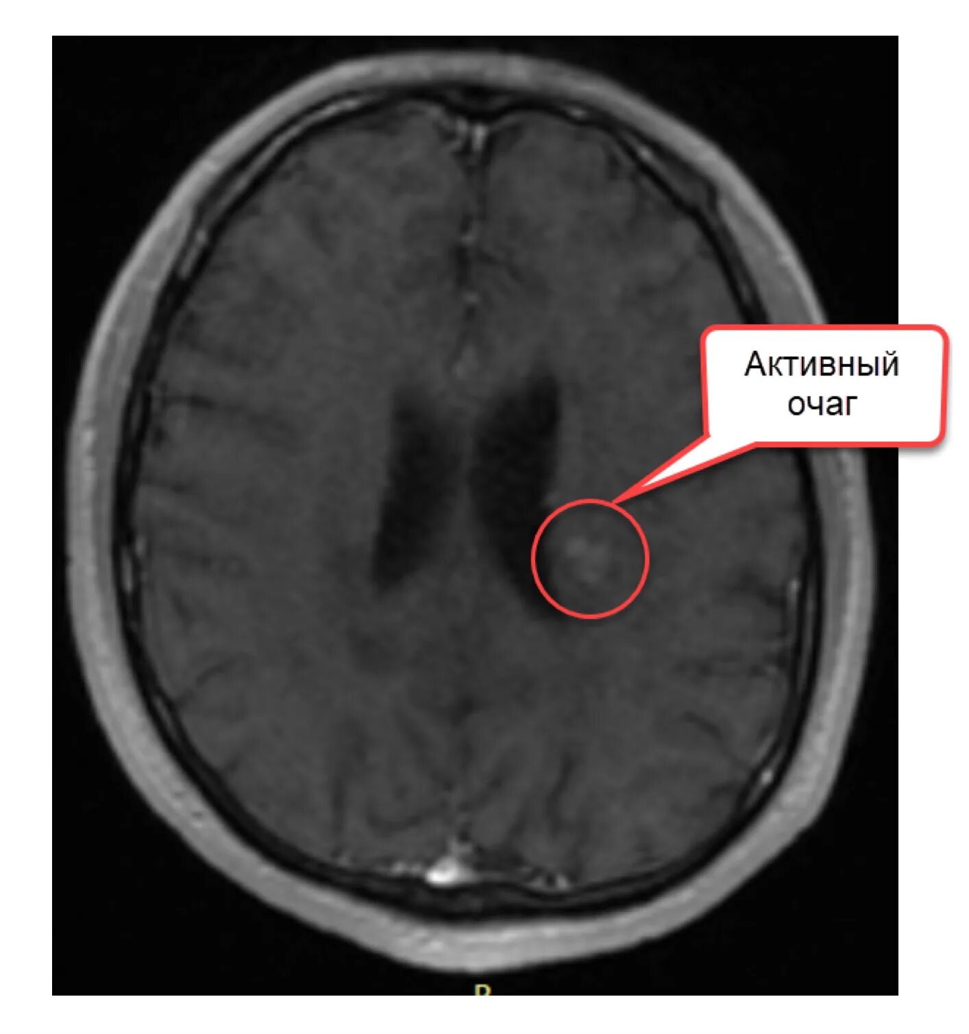Сосудистый очаг в головном мозге что это. Рассеянный склероз снимки мрт. Рассеянный склероз снимок мрт. Рассеянный склероз на мрт головного мозга. Как выглядит рассеянный склероз на мрт.
