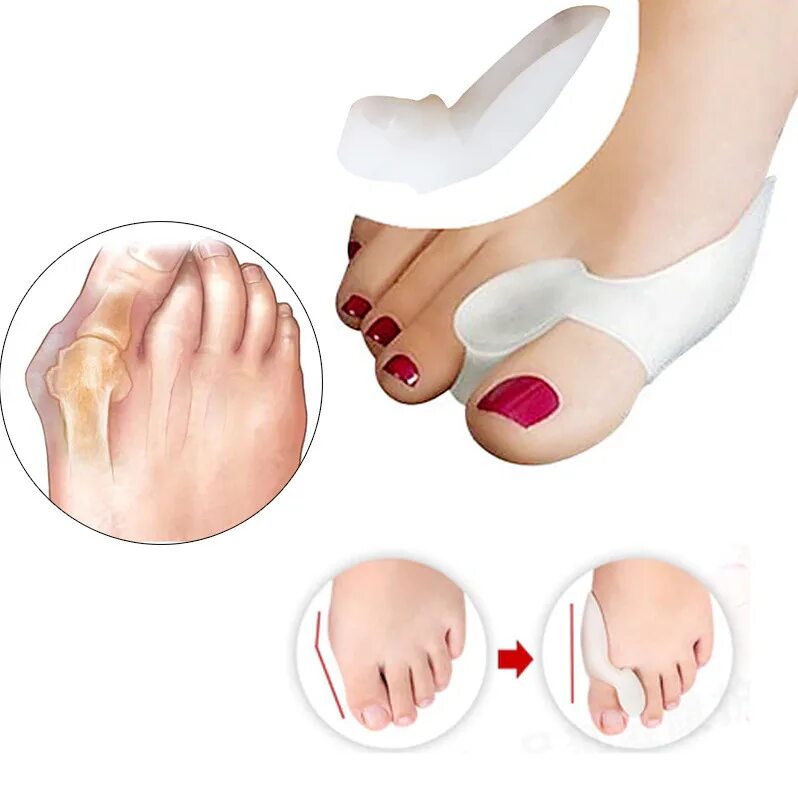 Фиксатор для hallux valgus. Силиконовые накладки на косточку. Накладки от мозолей. Силиконовый фиксатор для большого пальца ноги. Силиконовые накладки для ног от кривизны.
