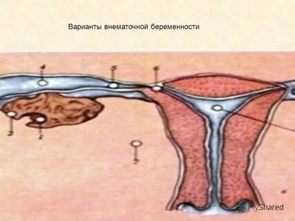 Операция при внематочной беременности