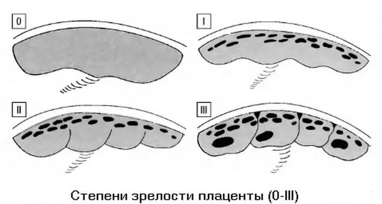 Норма зрелости плаценты. Стадии созревания плаценты по неделям таблица. 2 степень плаценты. Степени зрелости плаценты по неделям беременности таблица норма. Узи степени созревания плаценты.