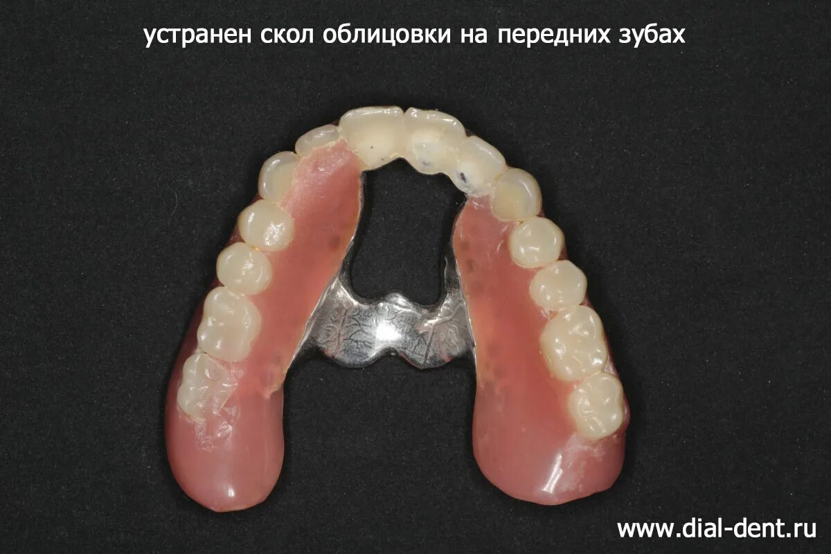 Срочный ремонт съемных протезов. Срочный ремонт съемных протезов