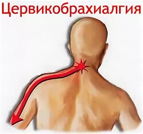 Как лечить вертеброгенную цервикалгию