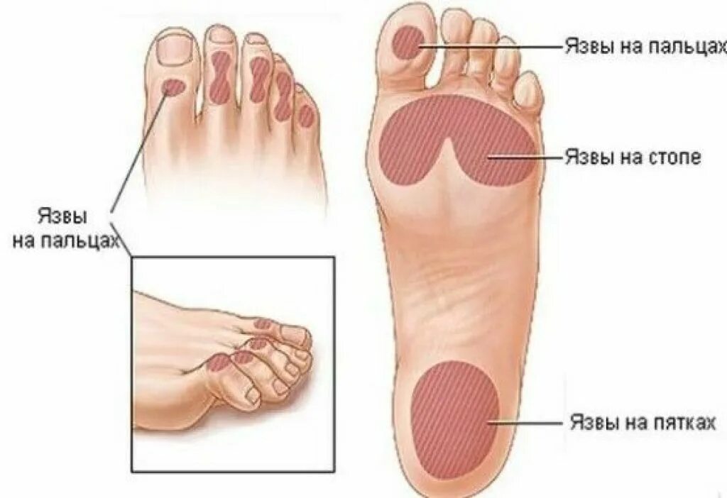 ноги больного сахарным диабетом. диабетические ногти на ногах. диабет пальцы ногах. гангрена пальцев стопы диабетическая. диабет пальцы ногах.