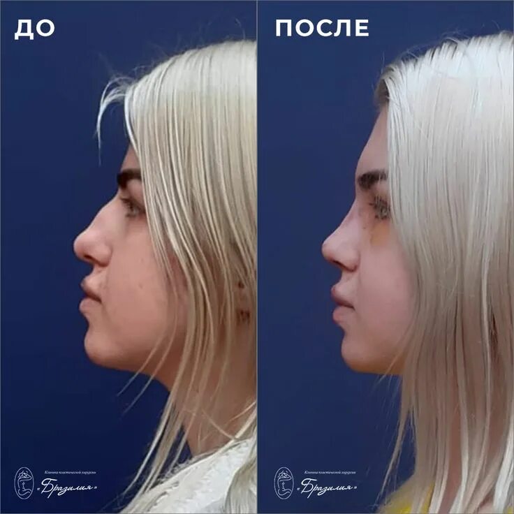 Ринопластика век до и после. Пластика калининград. Реновация хрущёвок в калининграде. Сказочные носы. Ринопластика калининград.