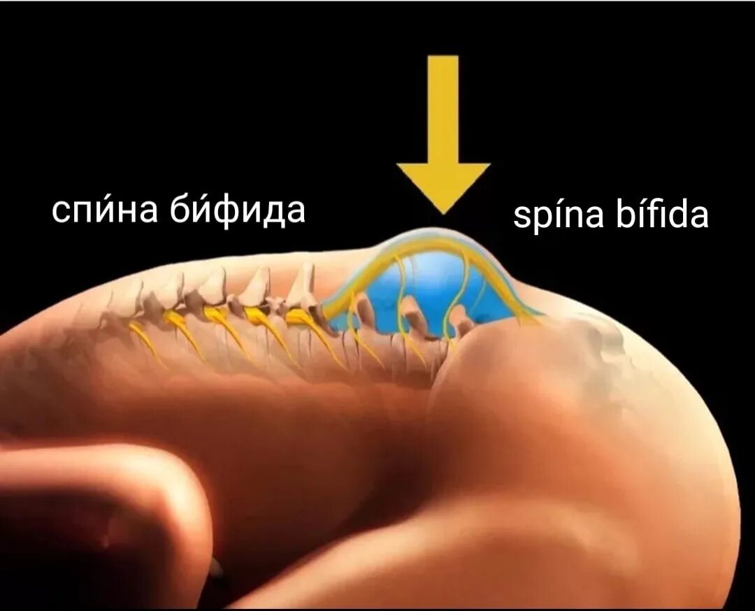 Спинномозговая грыжа. Spina bifida (расщепление позвоночника). расщелина позвоночника (spina bifida). менингоцеле менингомиелоцеле. спинномозговая грыжа spina bifida.