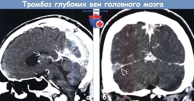 Мрт тромбоз. Тромбоз кавернозного синуса на кт. Тромбоз Вена Галена кт. Тромбоз вен головного мозга кт. Венозный тромбоз головного мозга кт.