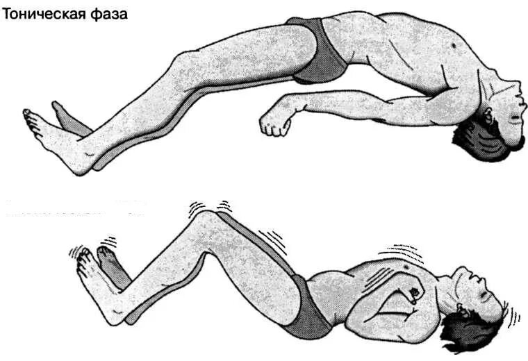 Тонические и тонико клонические судороги. Эпилепсия тонические и клонические судороги. Эпилепсия судорожный синдром. Тонические судороги у детей и клонические судороги.