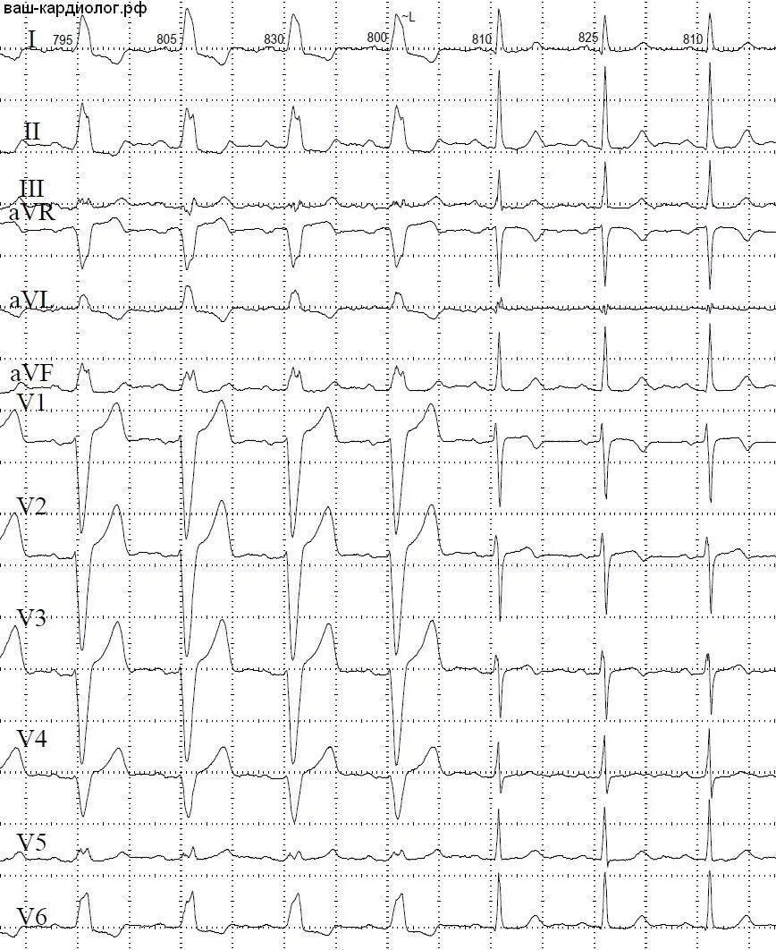 Блокада ножки левого предсердия. Полная блокада левой передней ножки пучка гиса. Трепетание предсердий с полной блокадой левой ножки пучка гиса. Блокада правого предсердия на экг. Блокады ножек пучка гиса на экг расшифровка.