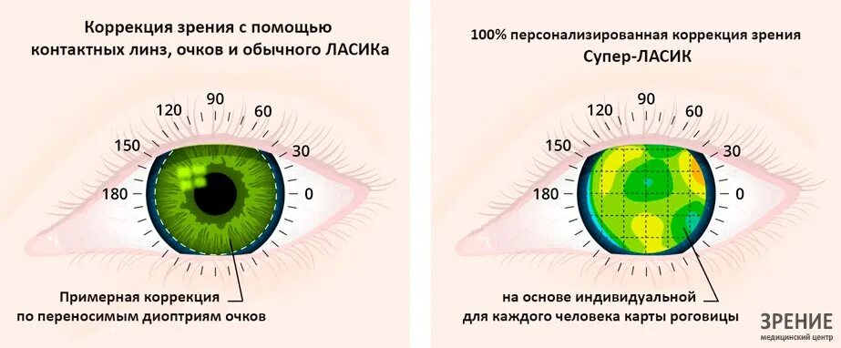 Сколько восстанавливается зрение после лазерной. Лазерная коррекция зрения методом ФРК. LASIK лазерный кератомилез. Метод ластика в коррекции зрения. Глаза после лазерной коррекции.