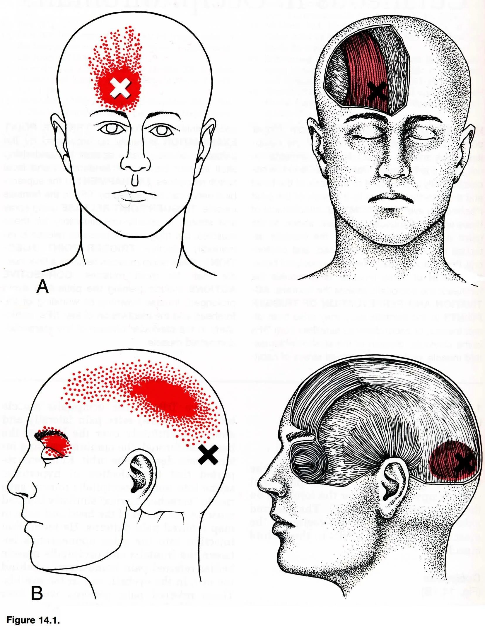 Сильная боль лобной. Триггерные точки головная боль мигрень. Болит голова триггерные точки. Триггерные точки при боли в затылке. Мышцы шеи и лица триггерные точки.