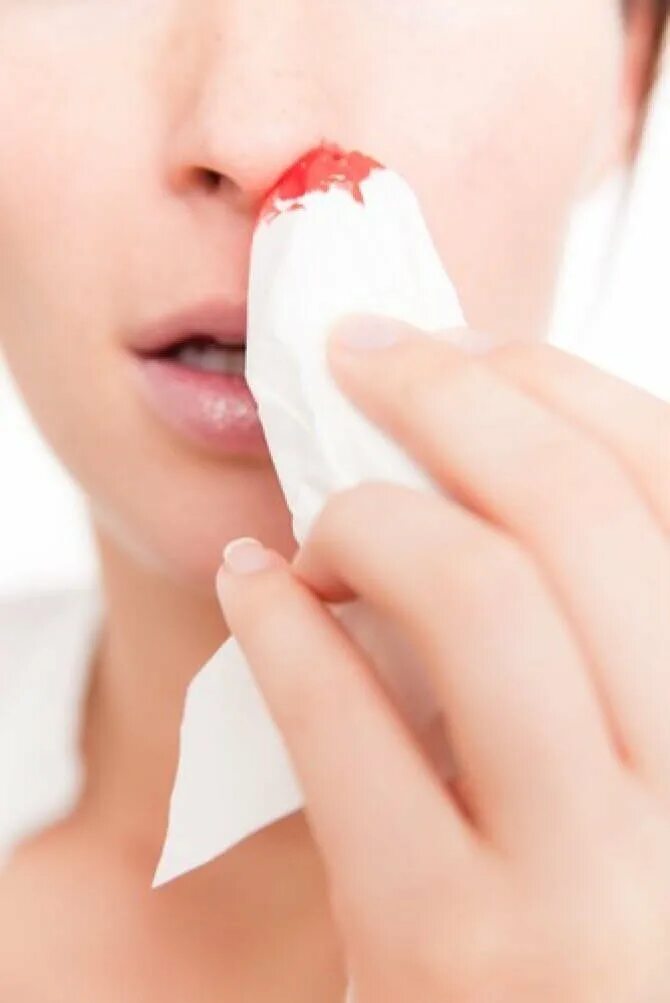 Носовое кровотечение у женщин