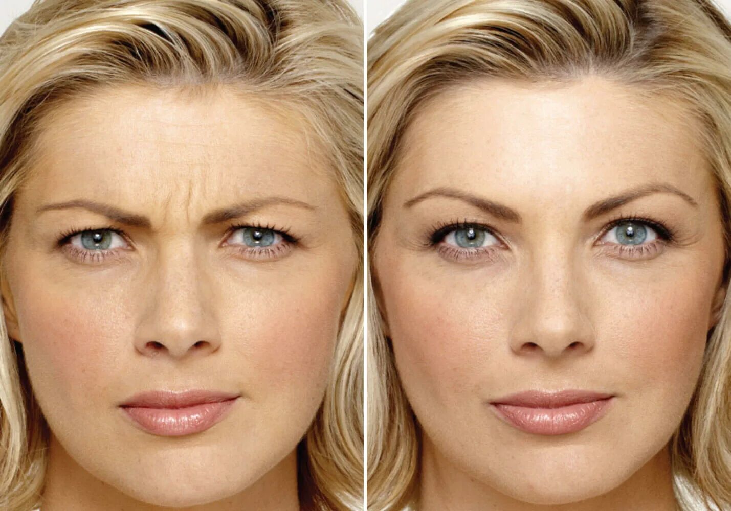 ботокс до и после фото. ксеомин препарат. ксеомин в белой упаковке. ксеомин дозировка. ксеомин отзывы фото.