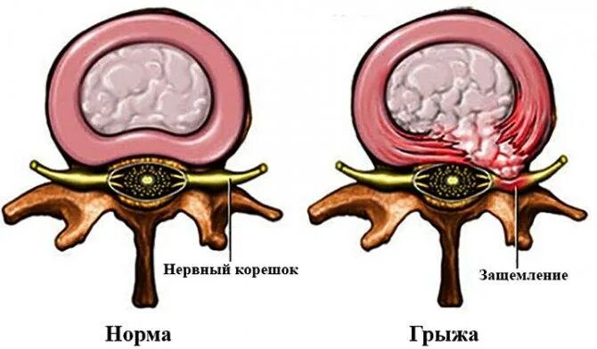 Секвестрированная экструзия. Секвестрированная грыжа позвоночника. Грыжа межпозвонкового диска операция. Эндоскопическая дискэктомия грыжи позвоночника.