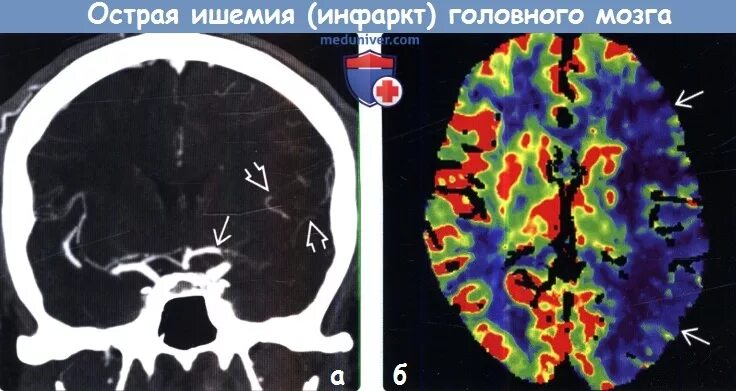 Левая средняя мозговая артерия инсульт. Ишемический инфаркт головного мозга. Инфаркт головного мозга кт. Ишемия головного мозга на кт. Подострый инфаркт головного мозга кт.