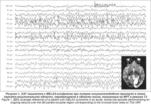 ээг принцип метода. ээг ребенка аутиста. ээг при аутизме у детей. ээг заключение норма. ээг показывает аутизм.
