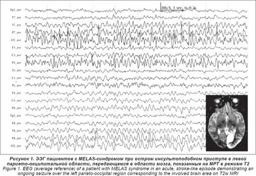 Ээг отзывы детям. Умственная отсталость на ЭЭГ. Миоклонический приступ на ЭЭГ. ЭЭГ при аутизме у детей. Энцефалопатия на ЭЭГ.