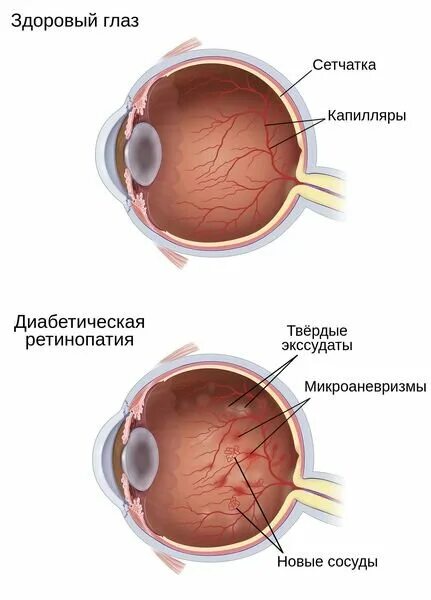 Глаза при диабете 2 типа. Ретинопатия сетчатки глаза. твердые экссудаты сетчатки. диабетическая ретинопатия. здоровый глаз и ретинопатия.