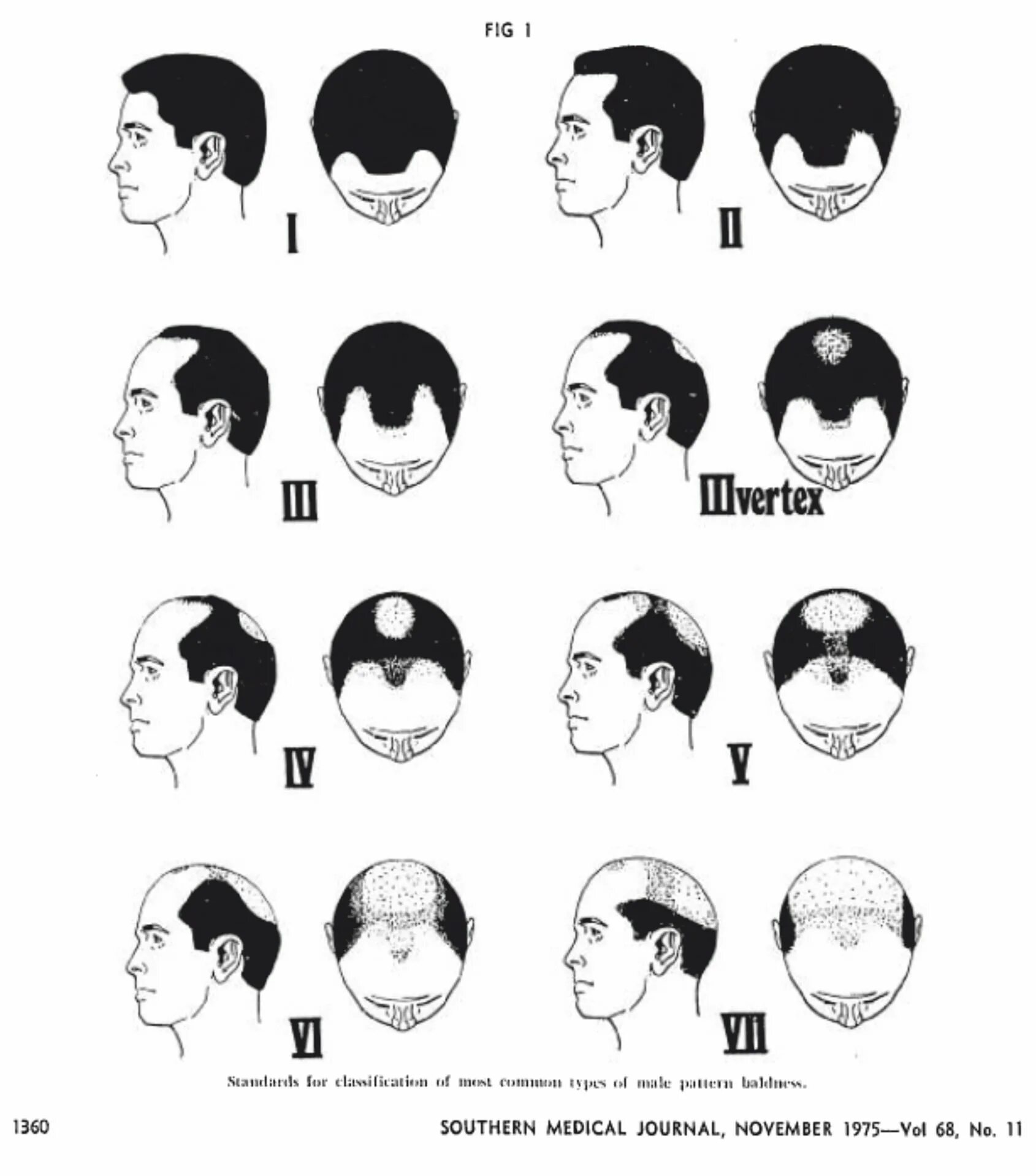 Форма затылка. Мужская алопеция шкала Норвуда. Шкала Норвуда облысение. Норвуд Гамильтон классификация. Андрогенная алопеция Гамильтон.