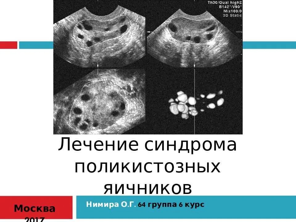 При поликистозе можно забеременеть. Синдром поликистозных яичников. (Синдром поликистозных яичников, синдром Штейна-Левенталя). Поликистоз яичников патанатомия. Поликистозные яичники патанатомия.