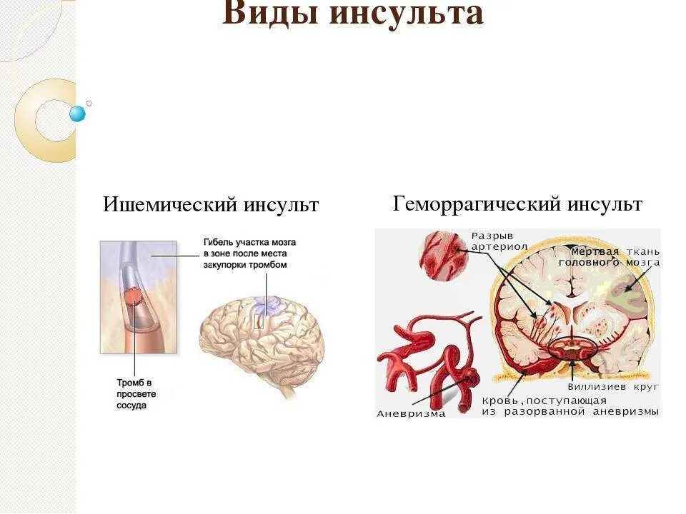 Инсульт органа. Виды ишемического инсульта. Инсульт типы инсульта. Виды инсультов головного мозга.