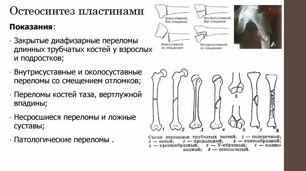 Перелом диафиза трубчатых костей. Механизмы переломов трубчатых костей. Основной симптом при переломе трубчатой кости. Классификация переломов трубчатых костей рентген. Этапы лечения переломов