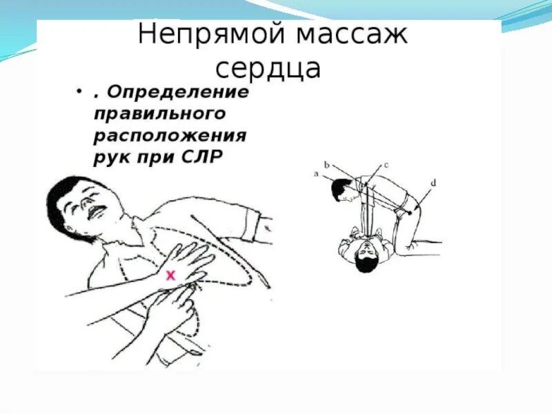 Как делать сердечную реанимацию правильно