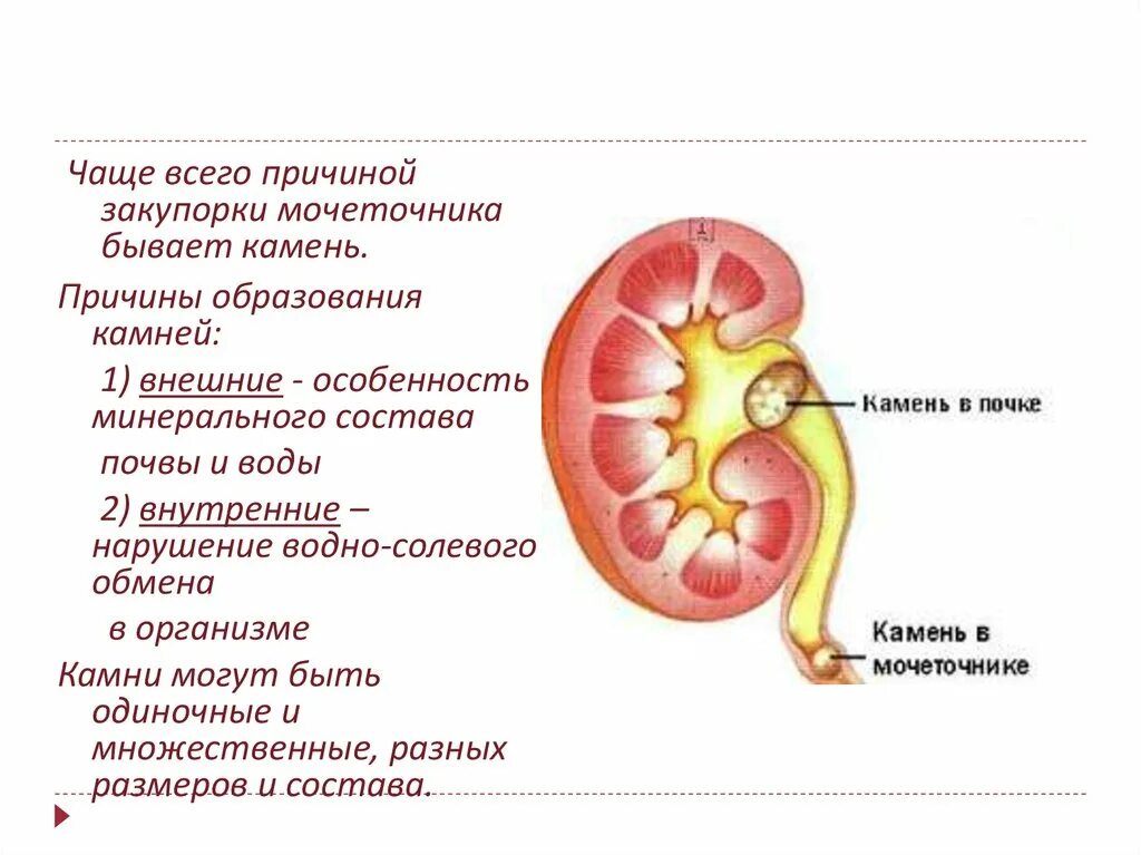 Мочевая колика. Локализация камней в почках.