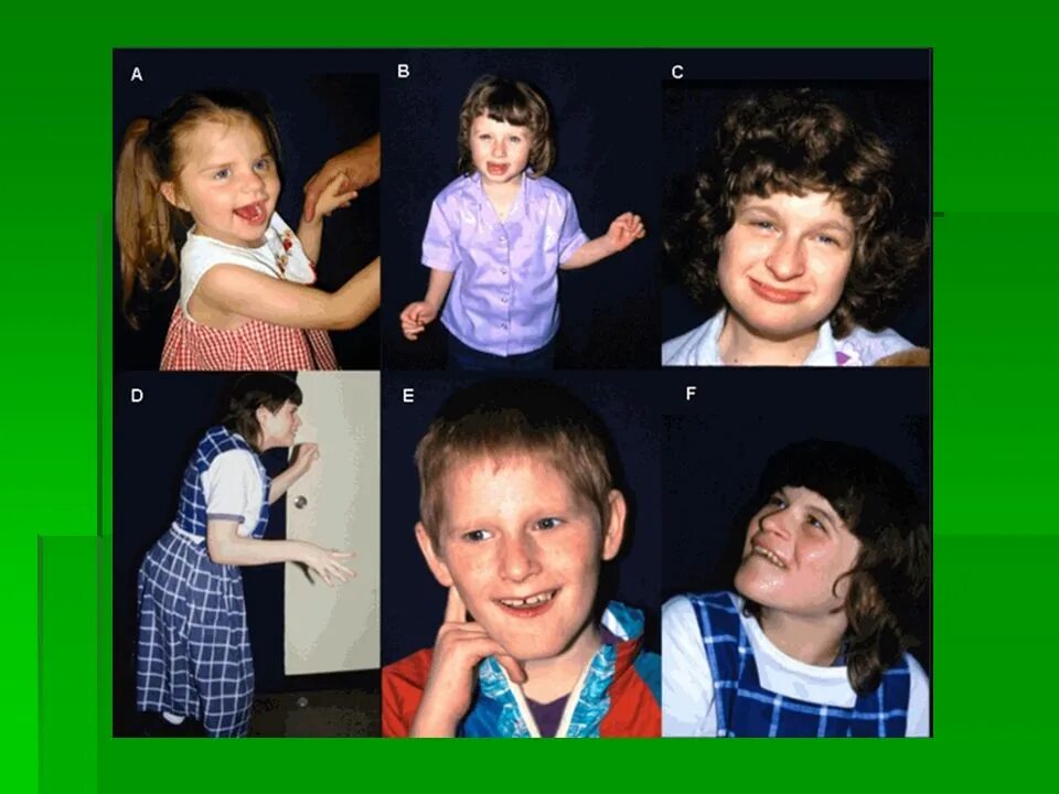 Синдром Ангельмана (синдром «счастливой куклы»). Генетический синдром Ангельмана. 15 Хромосома синдром Ангельмана. Синдром Ангельмана эпидемиология. Синдром 20 лет