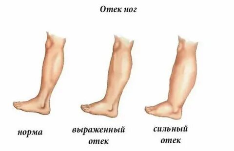 36 недель отекают ноги