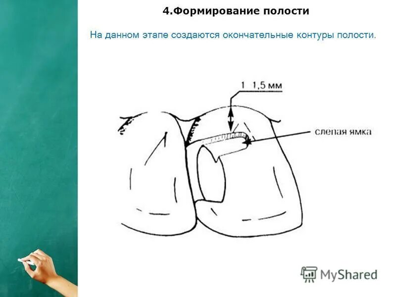 Полости в данном случае. Формирование кариозной полости. Формирование кариозных полостей 5 класса. Препарирование кариозных полостей 5 класса. Местные анестетики применяемые для аппликационной анестезии:.