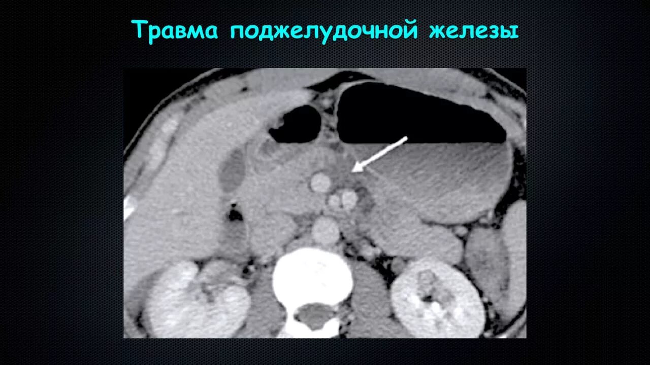 Химиотерапия поджелудочная железа