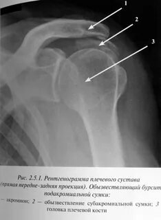 Склероз большого бугорка
