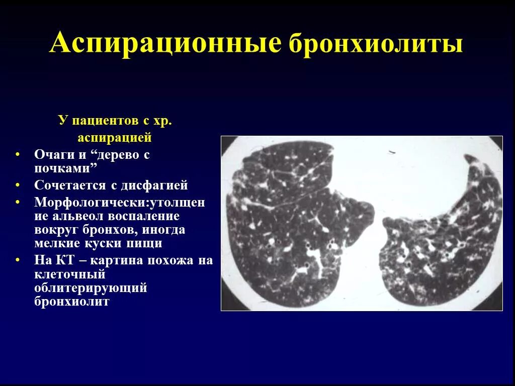 Дерева в почках в легких кт. Туберкулезный бронхиолит на кт. Облитерирующего бронхиолита кт. Респираторный бронхиолит кт картина. Облитерирующий бронхиолит на кт.