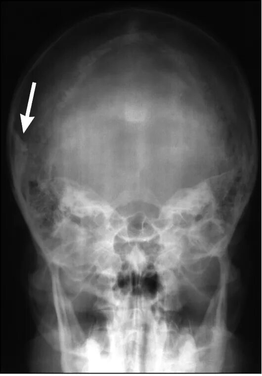 остеопетроз рентген черепа. кости черепа относятся к плоским. лучевая диагностика заболеваний головного мозга. расхождение швов черепа рентген. рентген черепа в боковой проекции норма.