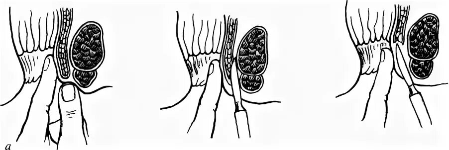 Трещина прямой. Боковая подкожная сфинктеротомия. Иссечение анальной трещины, дозированная сфинктеротомия. Подслизистая боковая сфинктеротомия. Сфинктеротомия при трещинах.