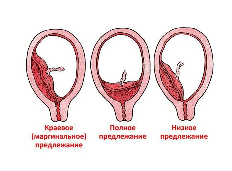 Типы прикрепления плаценты. Плацента краевое предлежание плаценты. Предлежание плаценты хориона. Полное и неполное предлежание плаценты.