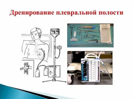 Дренаж плевральной полости