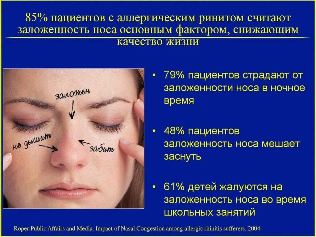 Не проходит заложенность носа чем лечить. Аллергические риносинусопатии. Проявления аллергического ринита. Аллергическая реакция на лице.