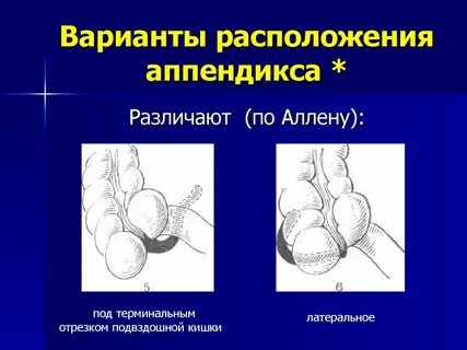 Аппендицит какое отделение