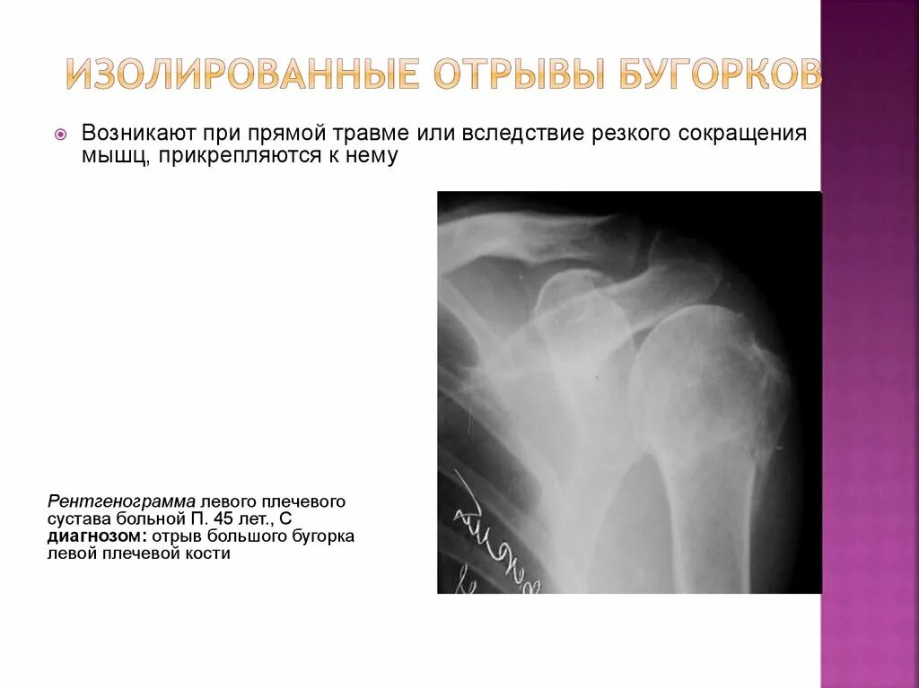 Оскольчатый перелом бугорка плечевой кости. Субкапитальный перелом плечевой кости. Перелом бугорков плечевой кости рентген. Гребень малого горбка плечовой кости. Плечевая кость большой бугорок.