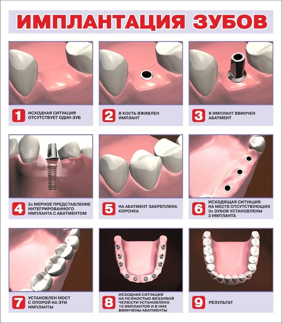 Через сколько можно вставить зубы. Этапы имплантации зубов абатмент. Как устанавливается имплант зуба. Этапы имплантации зуба абатмент. Этапы установки импланта зуба.