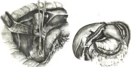 Резекция желудка по вальтеру. Биполярная резекция. Монополярная и биполярная коагуляция. Гольмиевая лазерная энуклеация предстательной железы. Трансуретральная резекция простаты (схема 2).