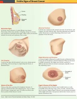 Nipple Discharge: Causes, Diagnosis and Treatment 