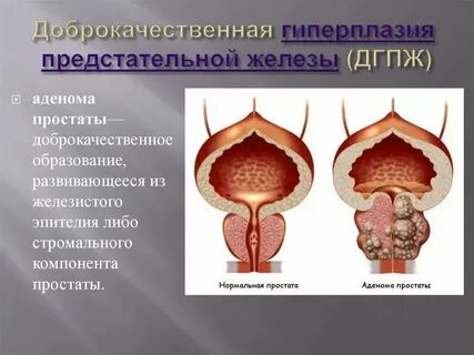 Предстательная железа что такое дгпж