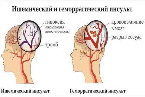 Тромб в голове лечение
