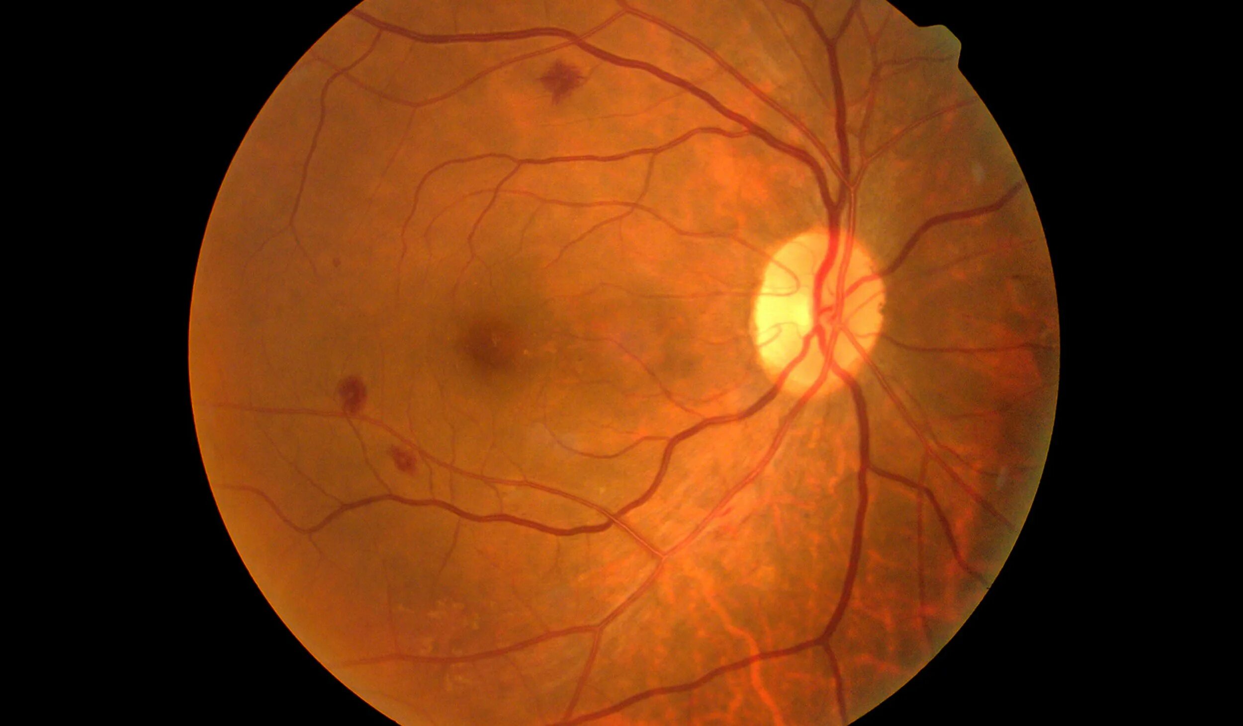 Ангиопатия сосудов головного. Пролиферативная ретинопатия. Пролиферативная диабетическая ретинопатия. Диабетическая ретинопатия глазное дно.