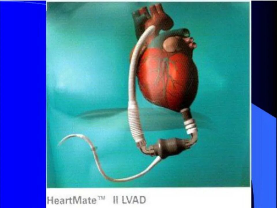 Искусственный левый желудочек сердца. Искусственное сердце аппарат. Искусственное сердце человека.