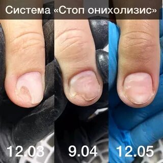 Лечение онихолизиса на руках препараты